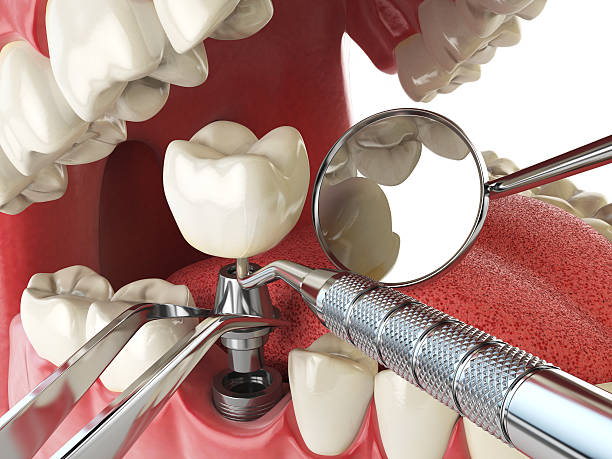 Best Emergency Tooth Extraction in Ames, IA